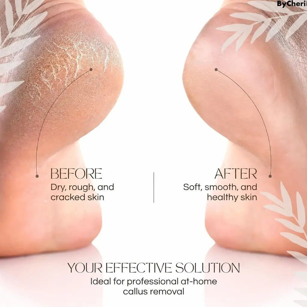 CallusMaster™ Electric Callus Remover for Foot Care | Nestilia