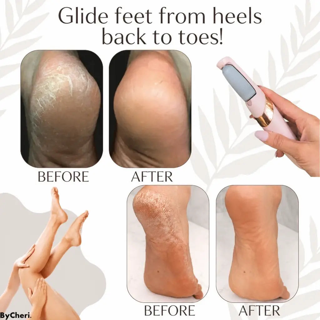 CallusMaster™ Electric Callus Remover | 50% OFF TODAY - Nestilia