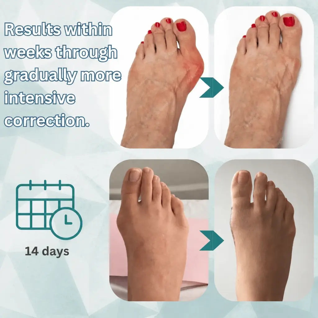 OrthoAlign™ – Big Toe Corrector | 1+1 FREE - Nestilia