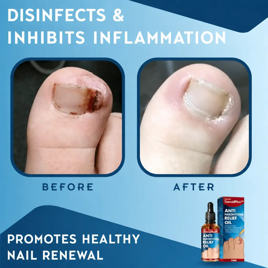 ToePerfect™ Disinfects and Inhibits Inflammation | Nestilia
