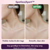 50% OFF TODAY | SpotlessXpert™ - Electric Beauty Spot Remover