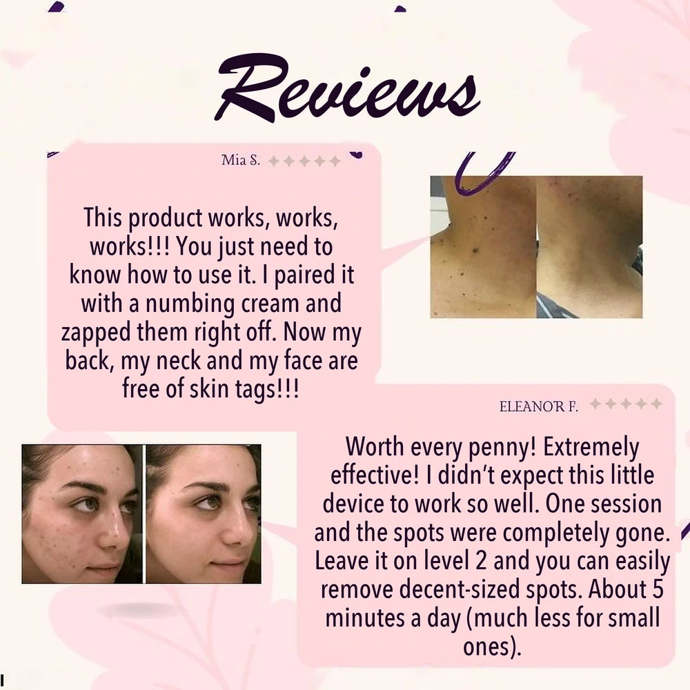 50% OFF TODAY | SpotlessXpert™ - Electric Beauty Spot Remover