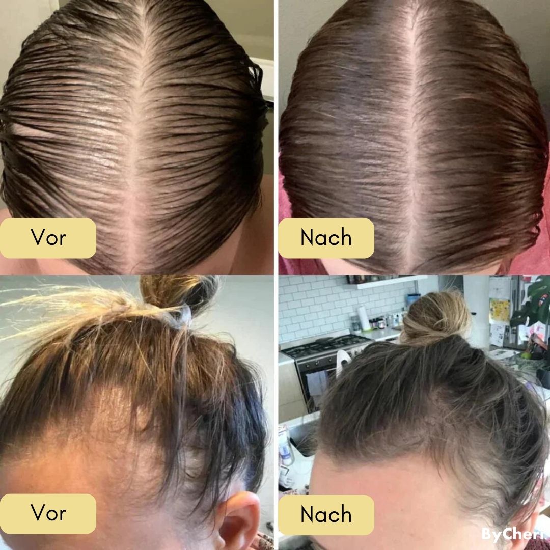 VitalGrow™ | Your Natural Oil Treatment for Hair Growth | 50% OFF