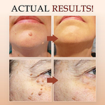 50% OFF TODAY  | ClearMole™ - Skin Tag & Wart Remover