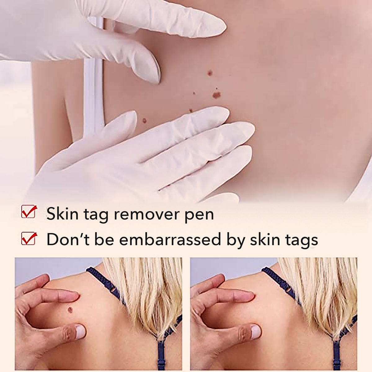 50% OFF TODAY  | ClearMole™ - Skin Tag & Wart Remover