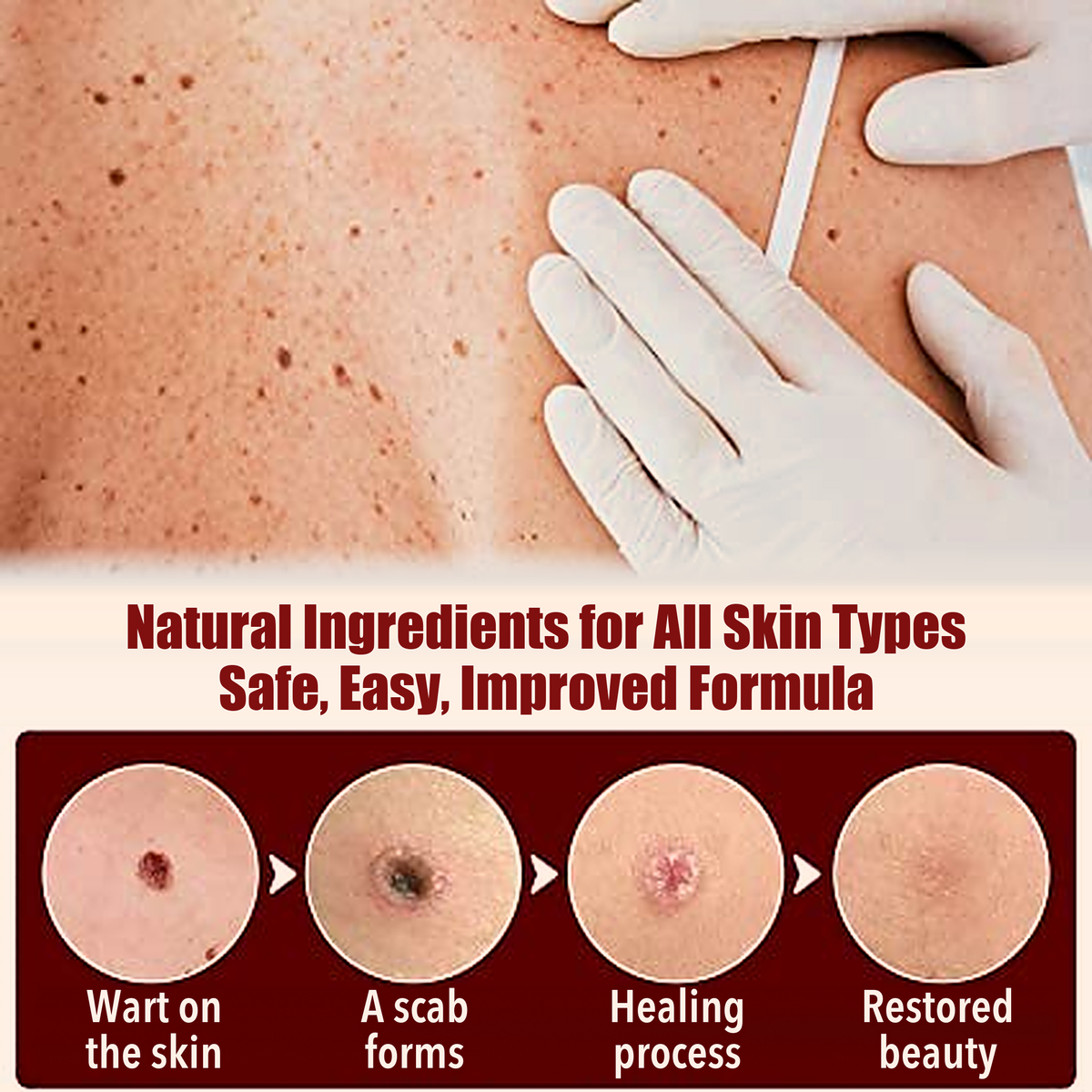 50% OFF TODAY  | ClearMole™ - Skin Tag & Wart Remover