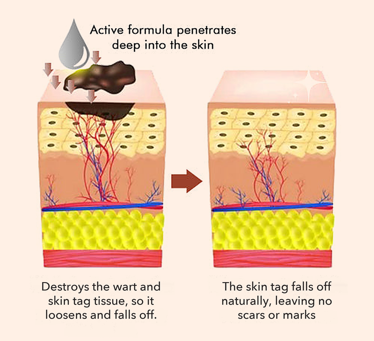 50% OFF TODAY  | ClearMole™ - Skin Tag & Wart Remover