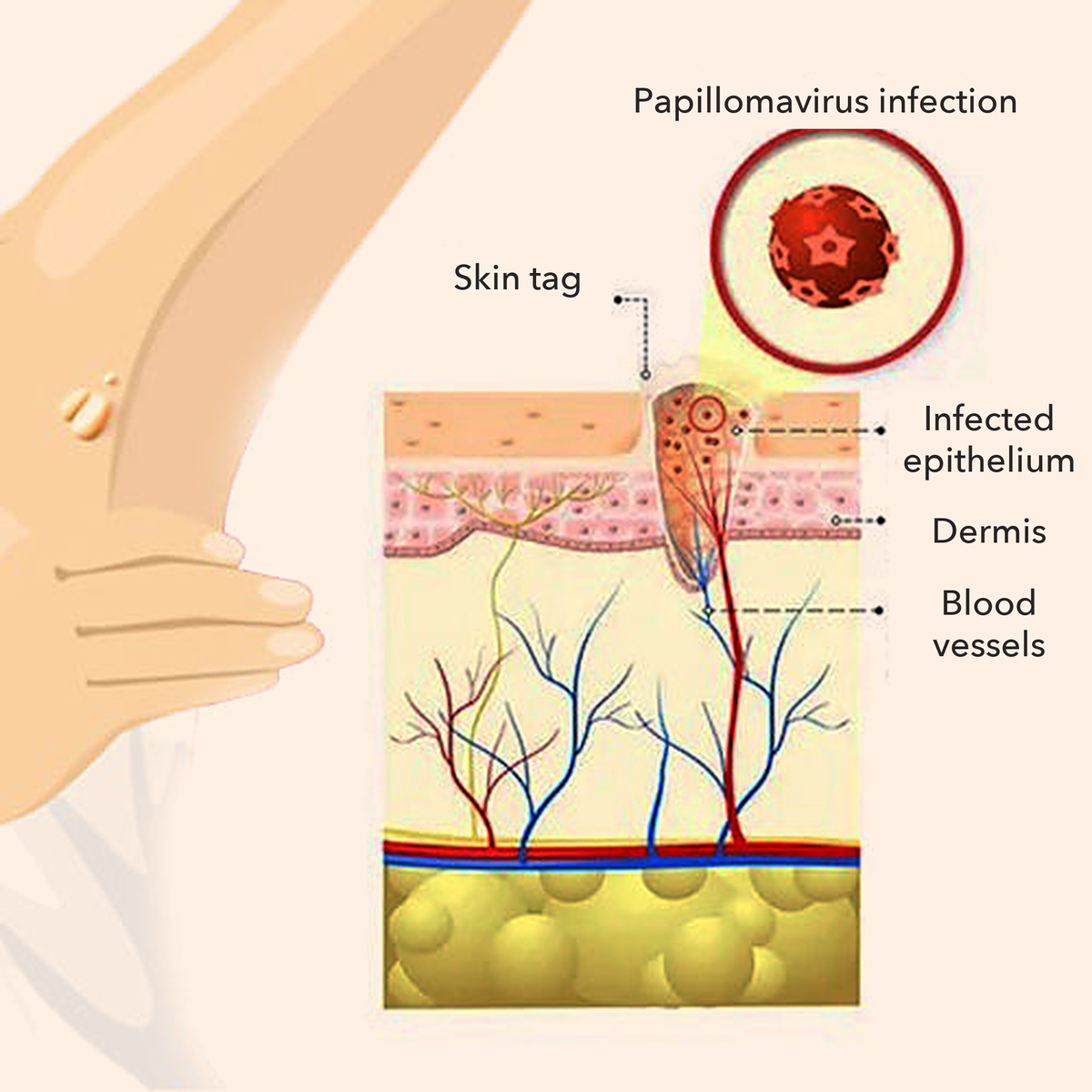 50% OFF TODAY  | ClearMole™ - Skin Tag & Wart Remover