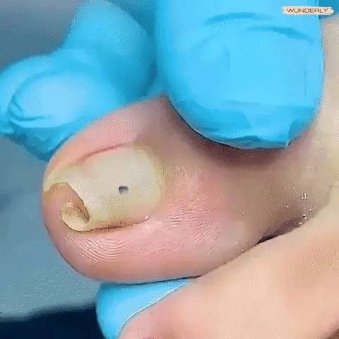 1+1 FREE TODAY  ToePerfect™ - Heals toenails and fingernails