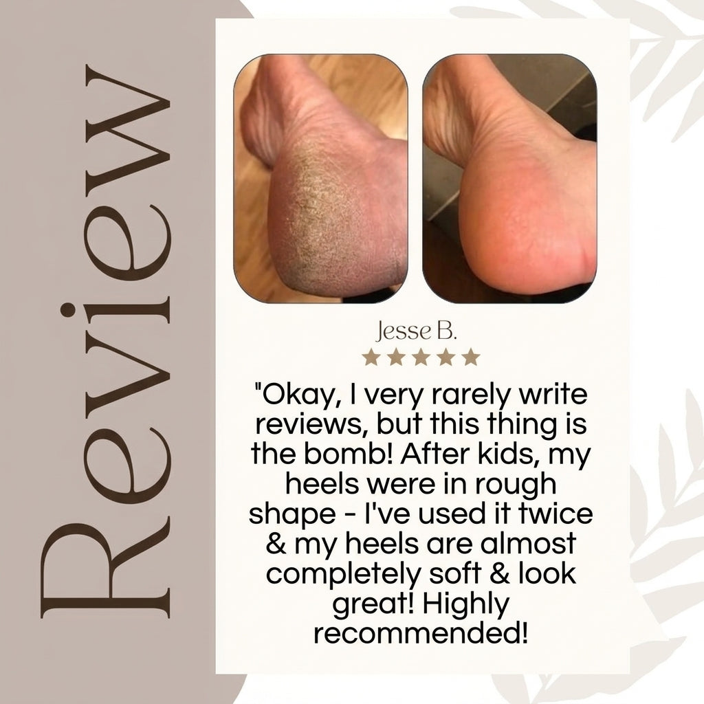 50% OFF TODAY | CallusMaster™ - Electric Callus Remover