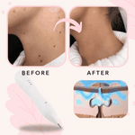 50% OFF TODAY | SpotlessXpert™ - Electric Beauty Spot Remover