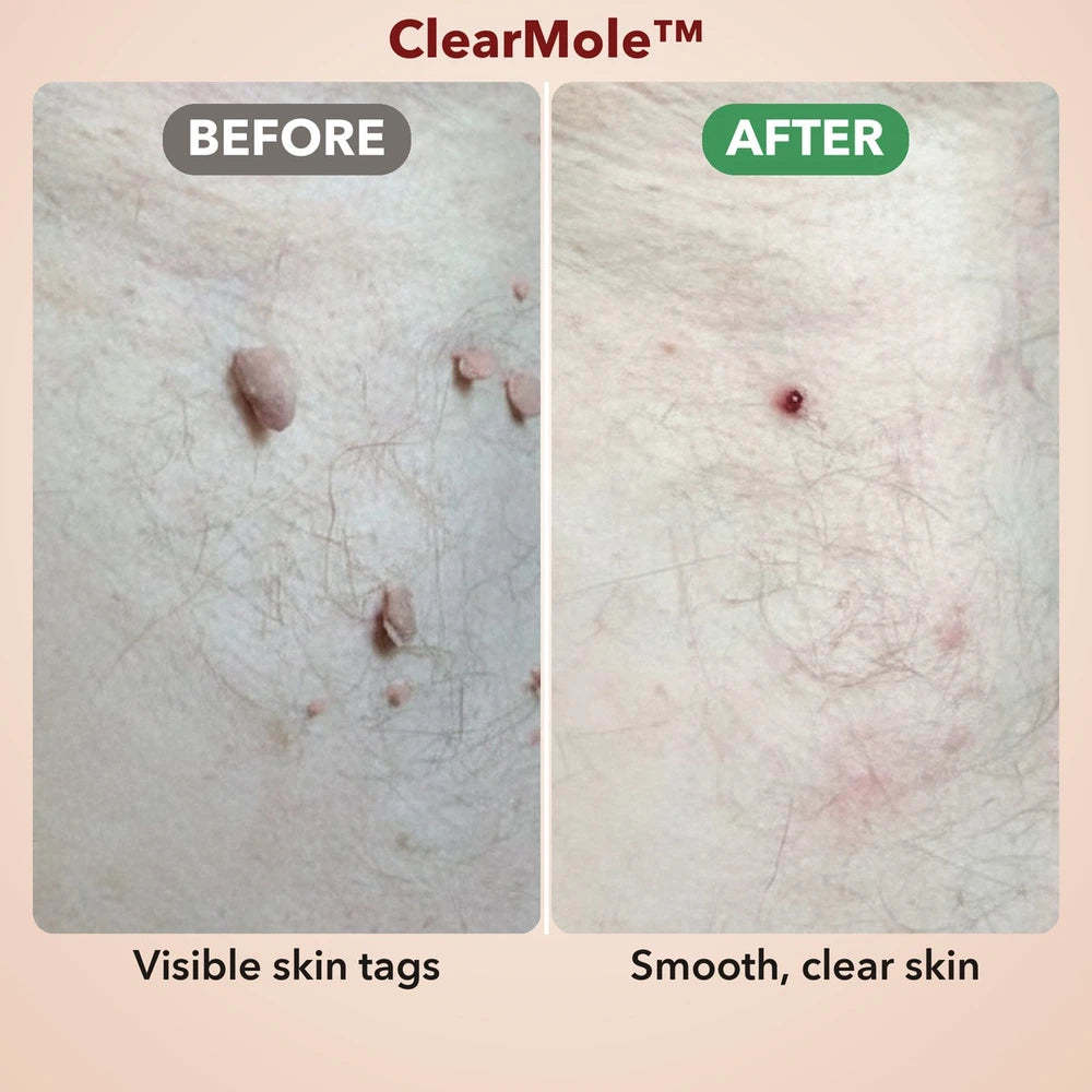50% OFF TODAY  | ClearMole™ - Skin Tag & Wart Remover