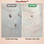 50% OFF TODAY  | ClearMole™ - Skin Tag & Wart Remover