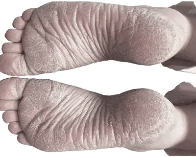 1 + 1 FREE TODAY  FootVitalize™ - Foot Finish Foot Repair Cream