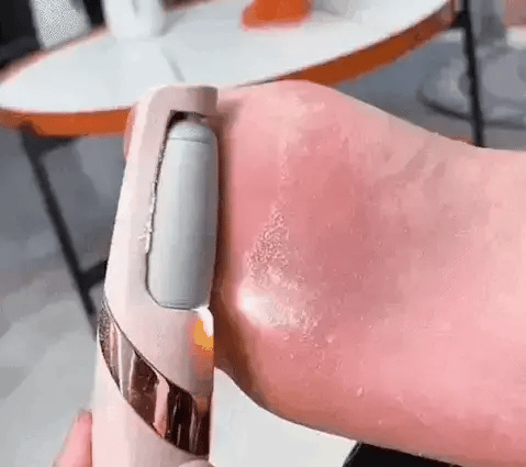 50% OFF TODAY  CallusMaster™ - Electric Callus Remover
