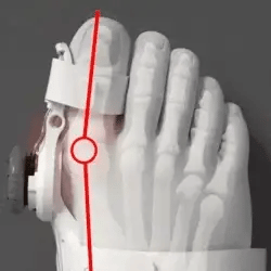 1 + 1 FREE TODAY  OrthoAlign™ - Big Toe Corrector