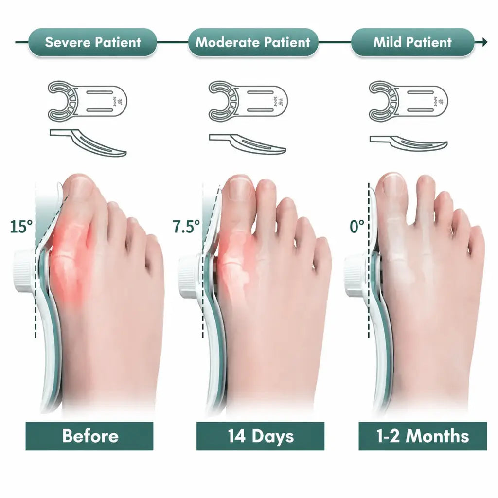 OrthoAlign™ – Big Toe Corrector | 1+1 FREE - Nestilia