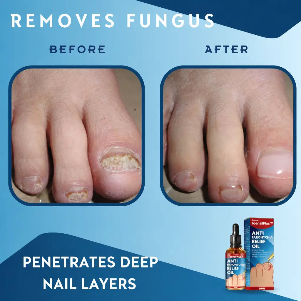 ToePerfect™ Removes Nail Fungus | Nestilia