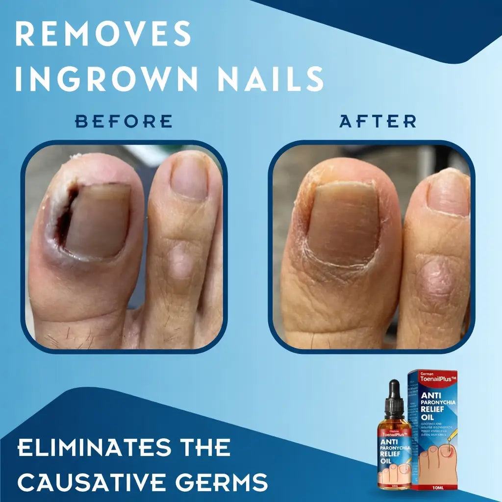 ToePerfect™ Removes Ingrown Nails | Nestilia