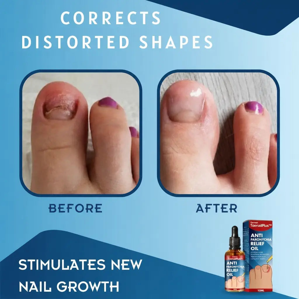 ToePerfect™ Stimulates New Nail Growth | Nestilia