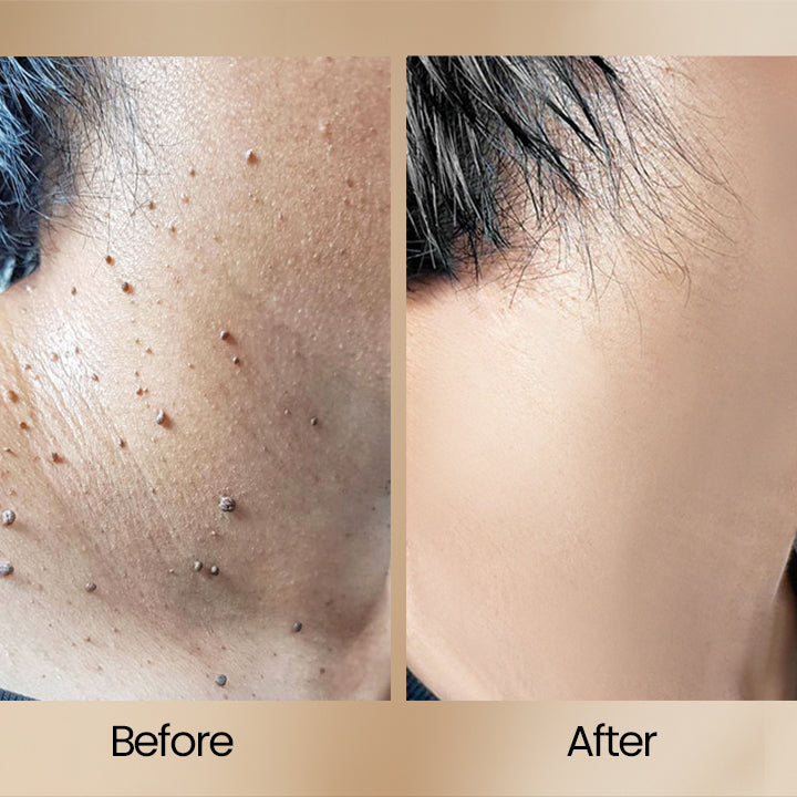1 + 1 FREE TODAY | ClearSkin™ - Bee Venom Wart Removal Spray