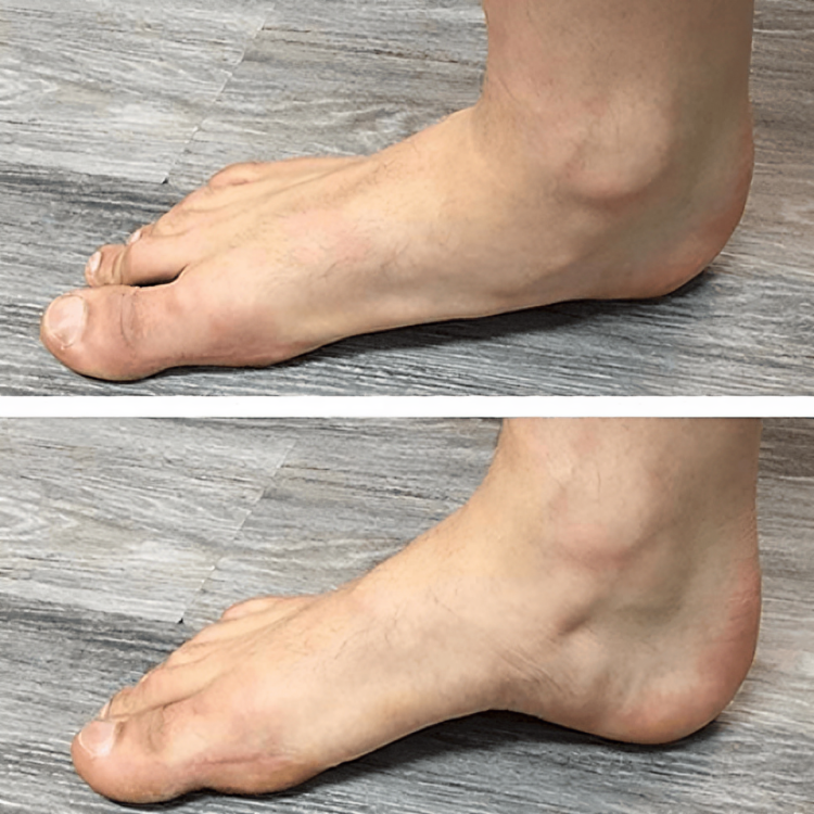 1 + 1 FREE TODAY | StepRelief™ | Orthopedic Foot Arch Support