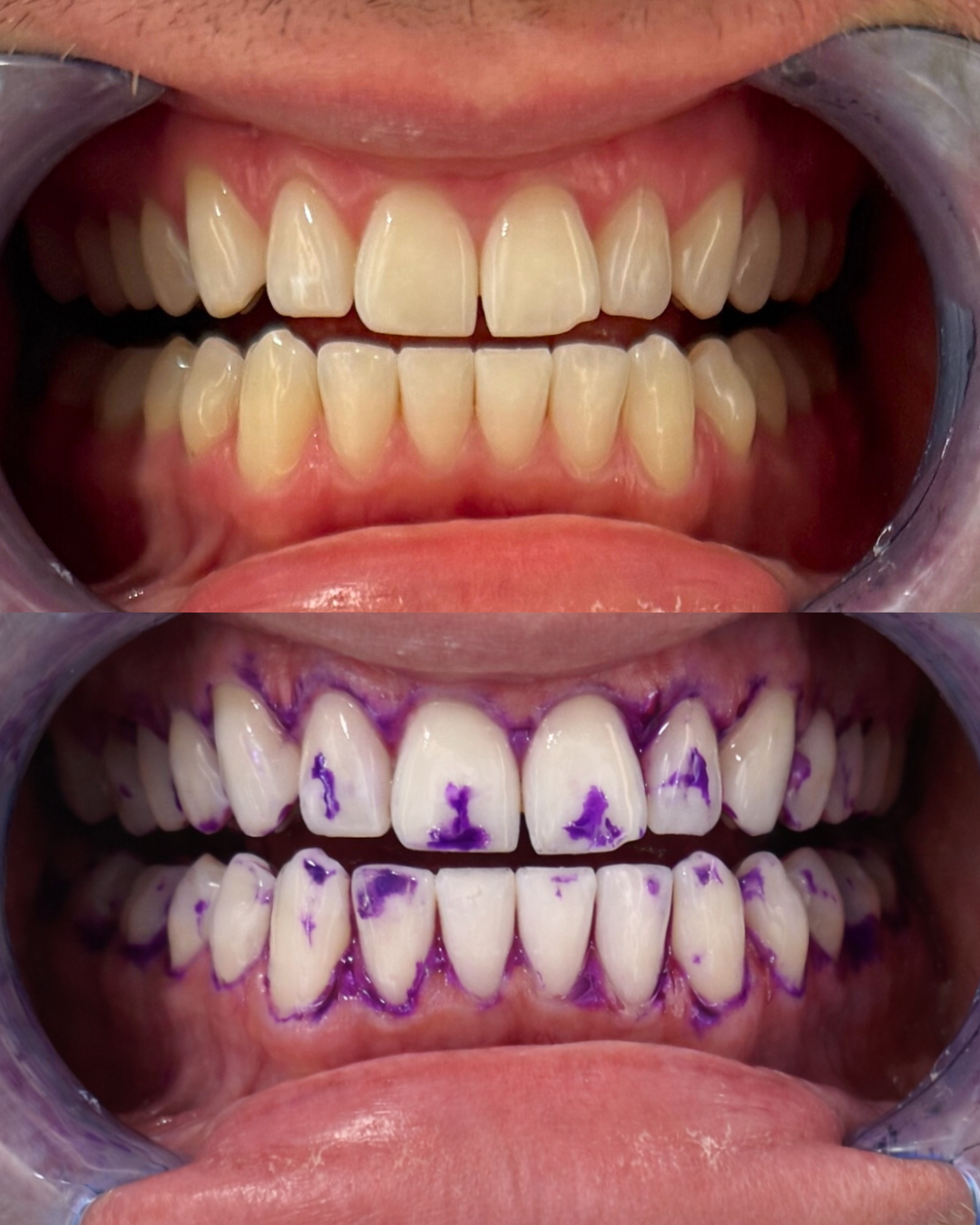 1 + 1 FREE TODAY | OraGlow™ Teeth Whitening Strips