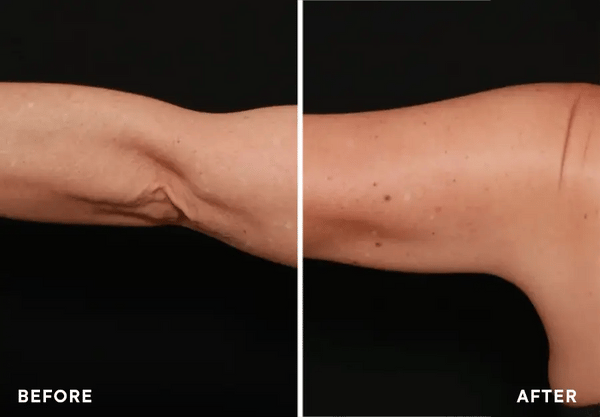 1+1 FREE TODAY  SmoothSculpt™ - Say hello to visibly firmer skin!